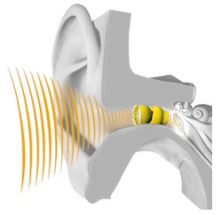 Nano Plug Hearing Aid